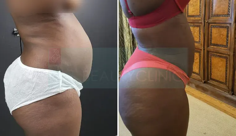 Vaser Liposuction Before And After