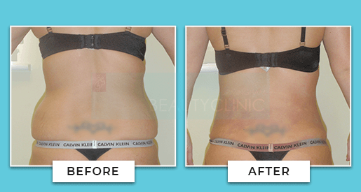Vaser Liposuction Before And After