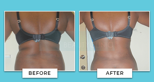 Vaser Liposuction Before And After