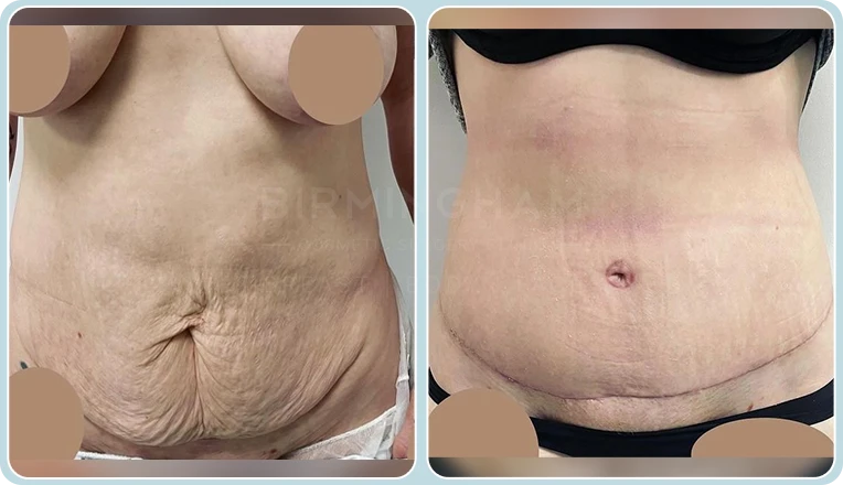 abdominoplasty before and after
