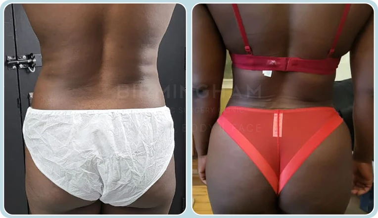 back vaser liposuction before and after