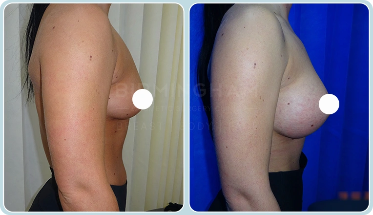 breast enlargement before and after result