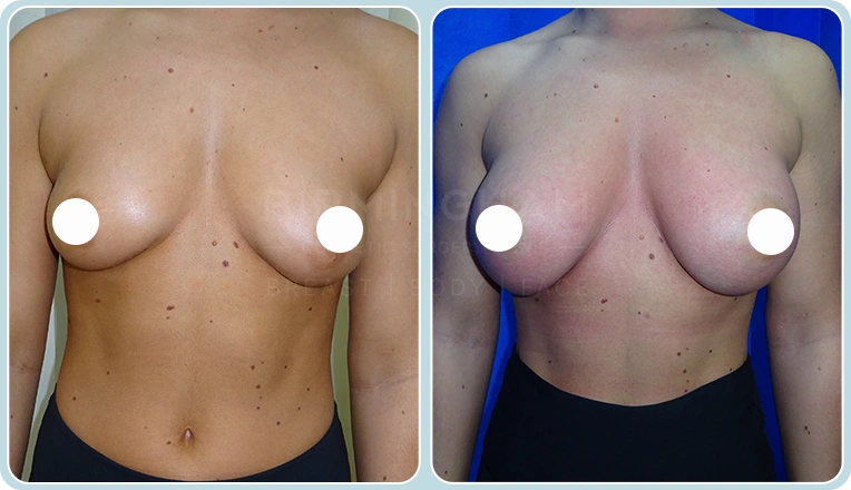 breast enlargement before and after result