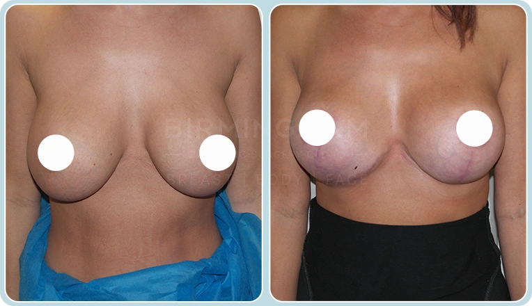 breast lift before and after result