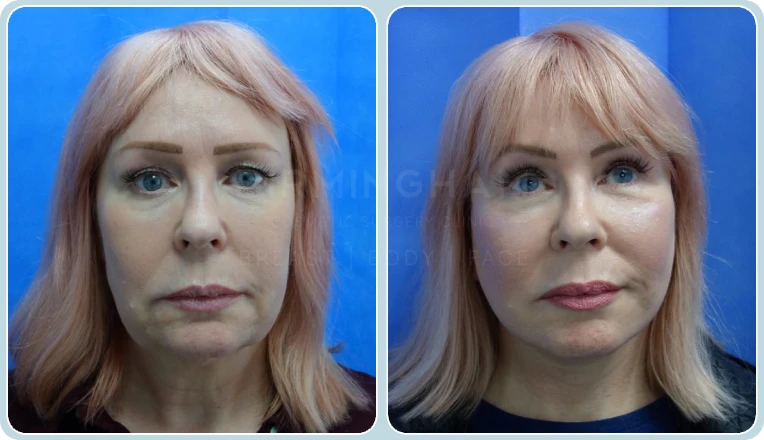 facelift before and after result
