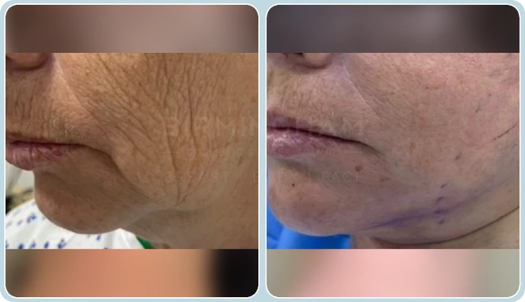 facelift before and after