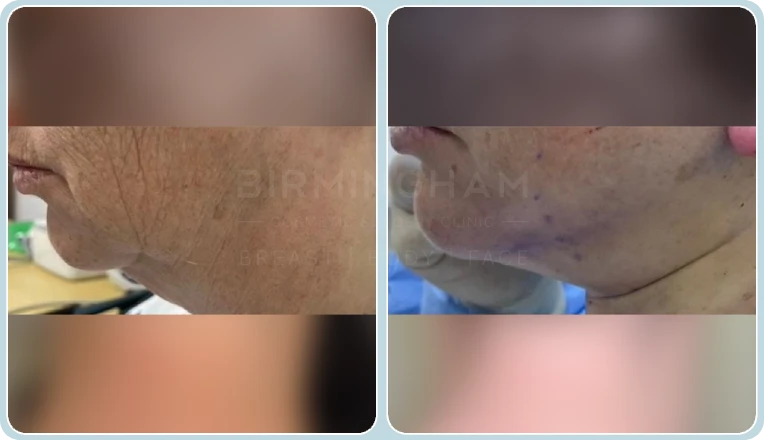 facelift before and after