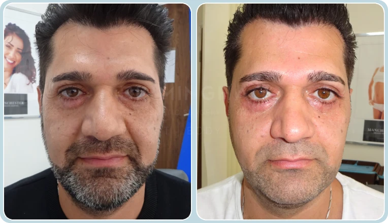 lower eyelid blepharoplasty before and after