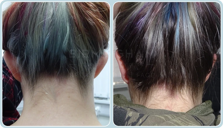 otoplasty before and after result