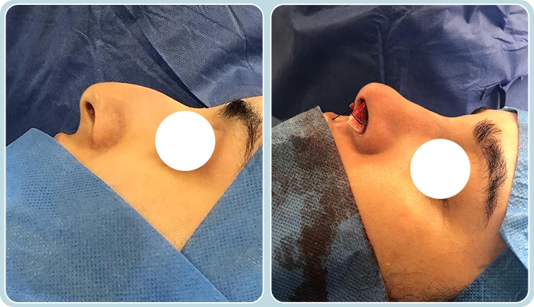 rhinoplasty before and after male patient