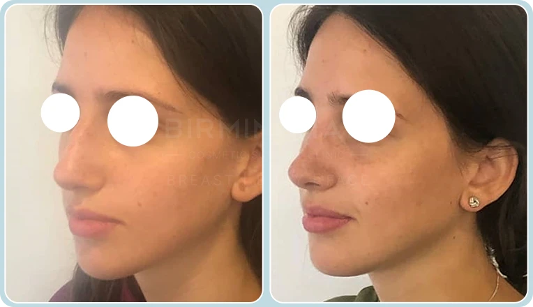 rhinoplasty before and after
