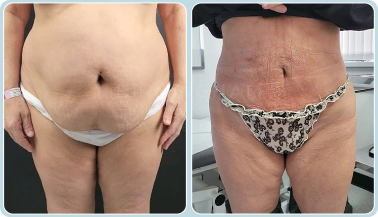 stomach vaser lipo before and after result