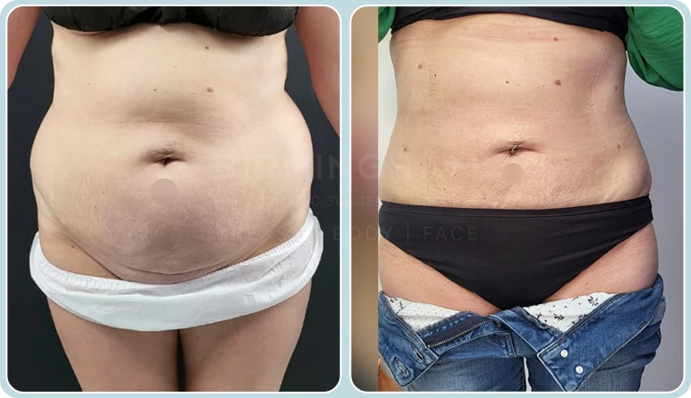 stomach vaser liposuction before and after result