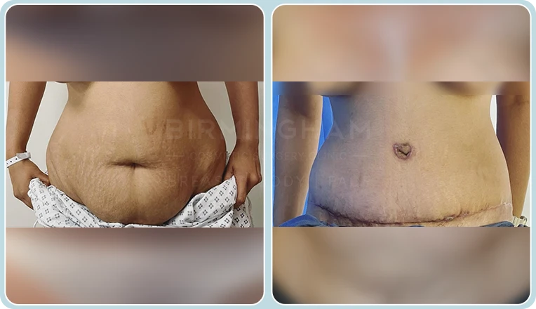 tummy tuck before and after result
