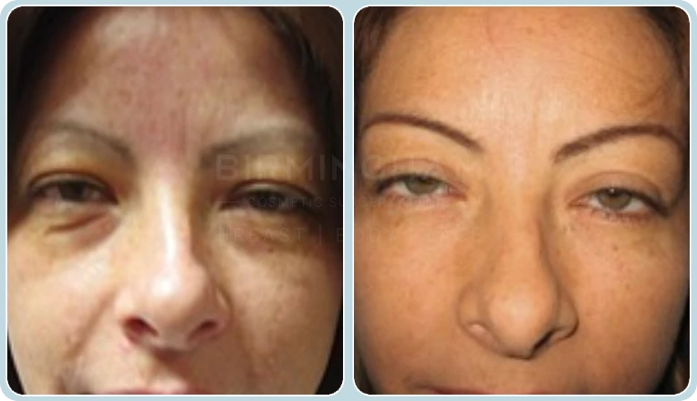 under eye blepharoplasty before and after result